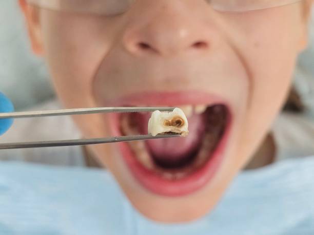 Best Emergency Treatment for Dental Infections or Abscesses in Erie, IL